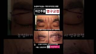 눈썹하거상술과 미간주름 동시교정 가능할까? #신촌성형외과 #마포성형외과 #미간필러부작용 #미간필러실명 #미간필러피부괴사 #상안검성형 # 윗눈거풀 처짐 #은평성형외과 #마포성형외과