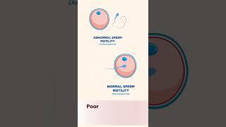 How Varicocele Affects Male Fertility – Explained | Surgery101Clinic