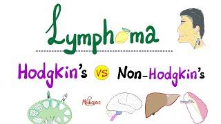 Hodgkin’s Lymphoma vs Non-Hodgkin's Lymphoma - Comparison - Hematology and Oncology