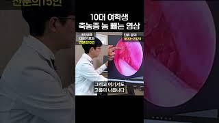 10대 여학생 축농증 농 뺴는 영상