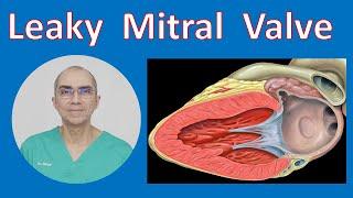 Leaky Mitral Valve - Mitral Valve Regurgitation