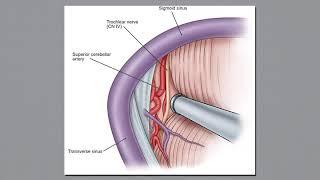 Lateral Supracerebellar Infratentorial Approach