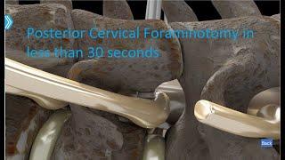 Posterior Cervical Foraminotomy 30 seconds