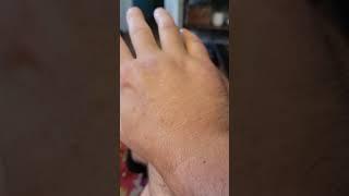 How to Tell If You Broke Your Pinky Knuckle, without Medical Advice, Boxer's Fracture