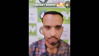 8 MONTHS OF HAIR TRANSPLANT EXPERIMENT CHANGED MY LIFE #shorts