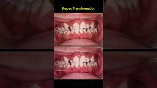 Braces 24 months - Crooked teetg #braces #dentist #orthodontist #dental