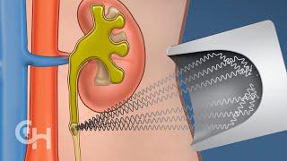 Shockwave Lithotripsy Surgery for Kidney Stones in Children