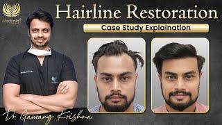 Transformative Hairline Restoration Case Study Hair Transplant Before After Results | Medlinks