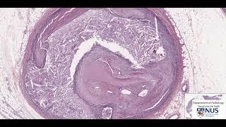 Coronary artery atheroma with organised thrombus virtual microscopy - Talking slide