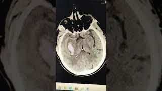Hemorrhagic Stroke during hypertensive crisis 60yo M
