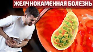 Желчнокаменная Болезнь: Симптомы и Лечение Желчнокаменной Болезни | Смотри и Знай