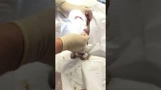 Exploding grapefruit sized sebaceous cyst popping.