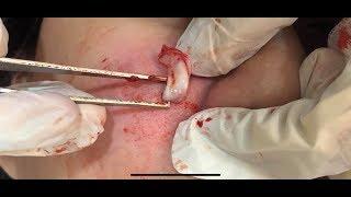 臉部粉瘤切除 美麗新城診所莊禮謙醫師 Minimal Incision, Epidermal Cyst, Great Healing, Dr George