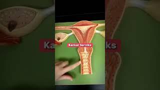 Kanker Serviks, Penyakit yang sering menyerang wanita #serviks #kanker #kesehatan #reproduksi #virus