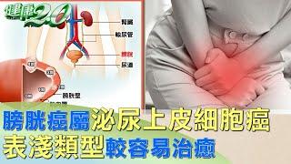 膀胱癌屬泌尿上皮細胞癌 表淺類型較容易治癒 健康2.0