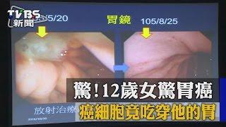 【TVBS】驚！12歲女驚胃癌　癌細胞竟吃穿他的胃