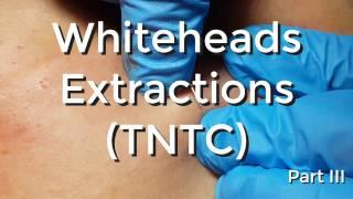 Whiteheads Extraction (TNTC) - Session I - Part 3 of 3