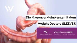 Das Weight Doctors SLEEVE® – die dauerhafte, endoskopische Magenverkleinerung ohne OP