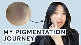 How I got rid of my pigmentation & dark spots | PicoWay Resolve