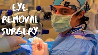 Enucleation Surgery (with Video), Explained by A Young Eye Surgeon **Educational**