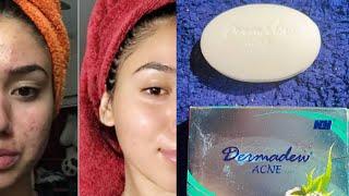 Dermadew Acne Soap effects|Side Effects|Results|Honest Review