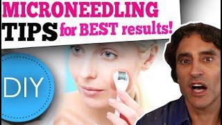 MICRONEEDLING DIY at HOME // What You Need to Know