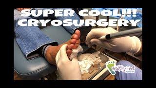 Super Cool Cryosurgery for Neuromas. Minimally Invasive Neuroma Surgery.