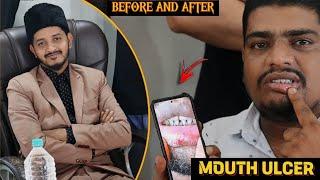 mouth ulcer se mile rahat sirf 2 se 3 din main | alhamdulillah Dr Attaullah khan