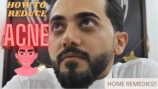 HOME REMEDIES FOR ACNE ! 2022 5 things you can do to Reduce Acne !