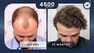 12 MONTHS RESULT! | 4500 GRAFTS HAIR TRANSPLANTATION with SMILE HAIR CLINIC