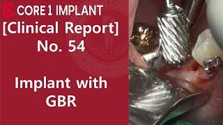 [CYBERMED Clinical Report] #45 Implant placement with Apically positioned flap