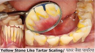 Yellow Hard Stone Like Tartar Removal in Teenager! Teeth Whitening/पायरिया का इलाजI Dr Ram MDS Delhi