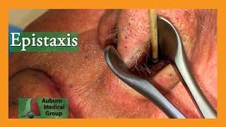 Epistaxis | Auburn Medical Group