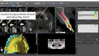 Blue Sky Bio Automatic Alignment of STL Files for Partially Edentulous Arches