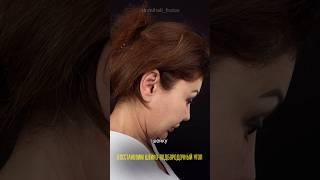 Из Канады в Россию. Фейслифтинг в технике deep plane. Доктор ФРОЛОВ МИХАИЛ