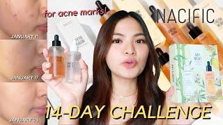 14-DAY CHALLENGE TO FADE DARK SPOTS USING NACIFIC DAY & NIGHT SET!  (With Photos) • Joselle Alandy