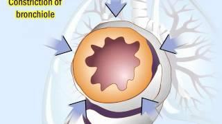 COPD: Pathophysiology and Diagnosis