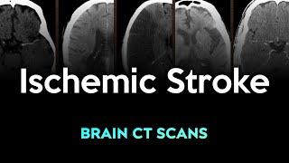 Ischemic Stroke: Brain CT Scans