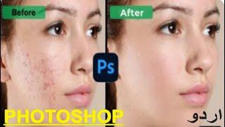 Advance High Level Skin Retouching In Photoshop / Remove Acne and Pimples IN 2023