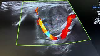 Ultrasound of submandibular sialolithiasis