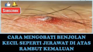 CARA MENGOBATI BENJOLAN KECIL SEPERTI JERAWAT DI ATAS RAMBUT KEMALUAN