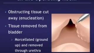 Holmium Laser Enucleation of the Prostate (HoLEP) for Benign Prostatic Hyperplasia (BPH)