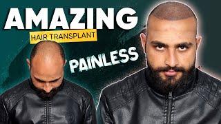 Hair Transplant in Lucknow | Best Results & Cost of Hair Transplant in Lucknow