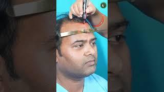 Best Hair Transplant Technique #shorts