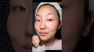 How I got rid of sunspots hyperpigmentation #shorts #skincare #melasma