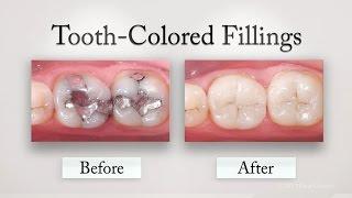 Tooth Colored Fillings