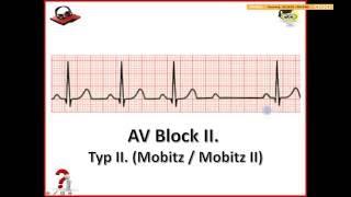 Ekg Podcast 25 of 59. AV Blokády. 3. Časť