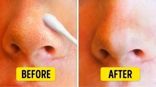 9 Natural Ways to Get Rid of Blackheads on Nose