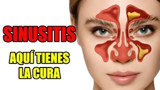  SINUSITIS | ¿Cómo CURAR la SINUSITIS rápido? Sigue estos pasos