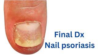 Nail Psoriasis: Recognizing Nail Pitting, Onycholysis, and More!